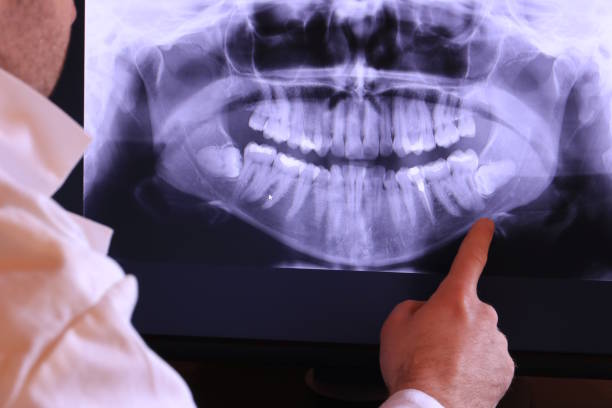 Best Emergency Dental Care for Abscessed Tooth in Morse, LA